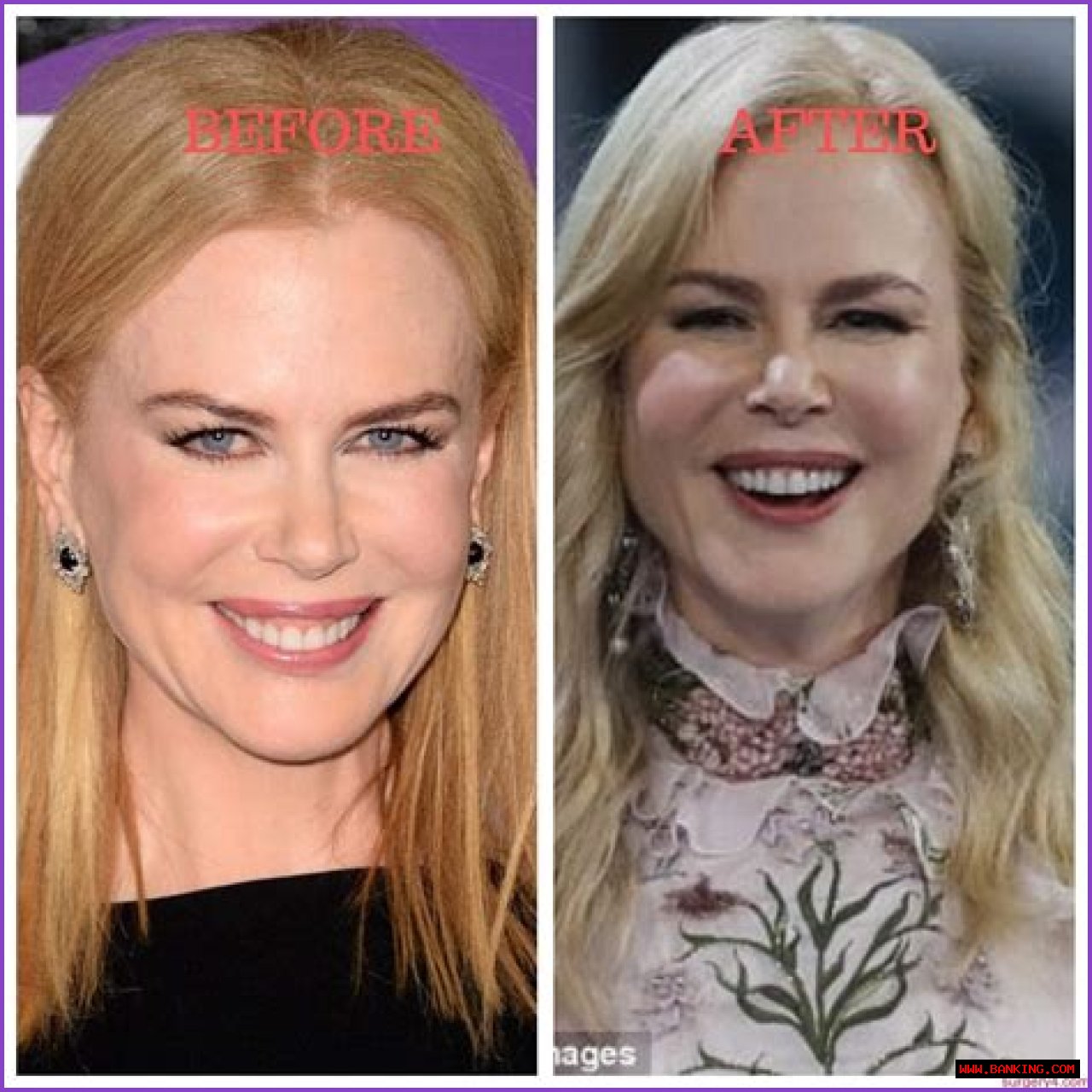 Nicole Kidman's 'Lioness' Plastic Surgery: Uncovering Hidden Truths
